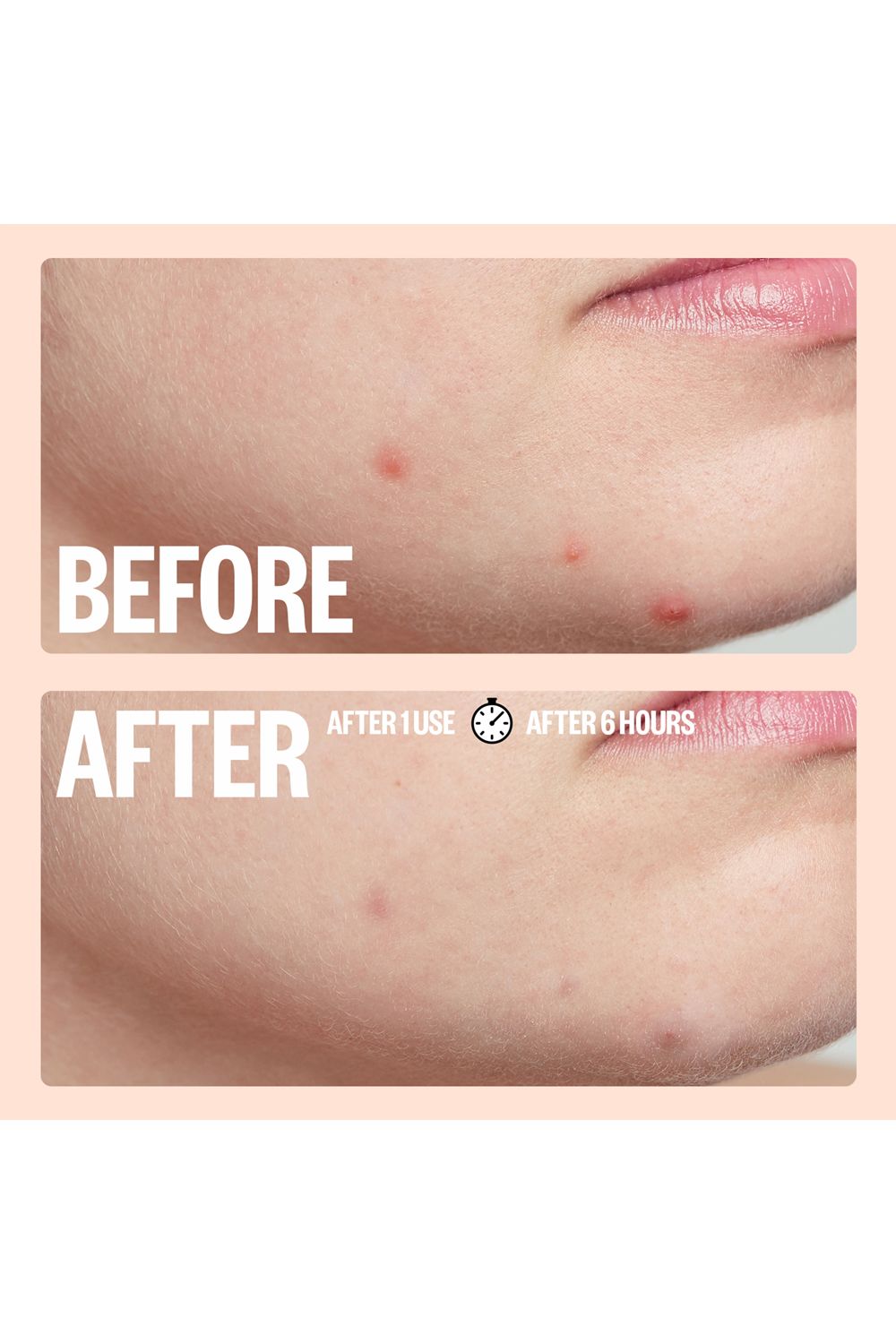 Peace Out Acne Dots - 20 Dots Multi image 6