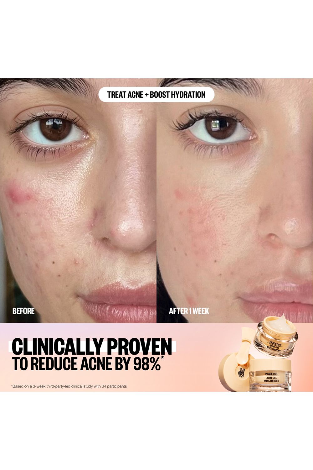 Peace Out Acne Moisturiser with 2% Salicylic Acid 50ml Multi image 4