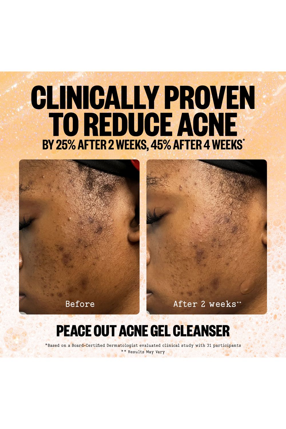 Peace Out Acne Cleanser 50ml Multi image 9