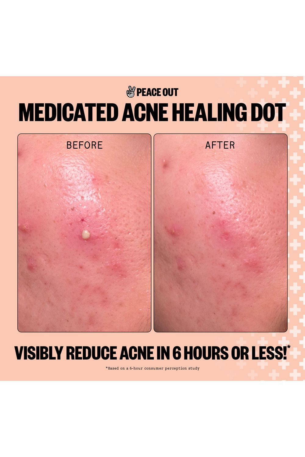 Peace Out Acne Dots - 20 Dots Multi image 8