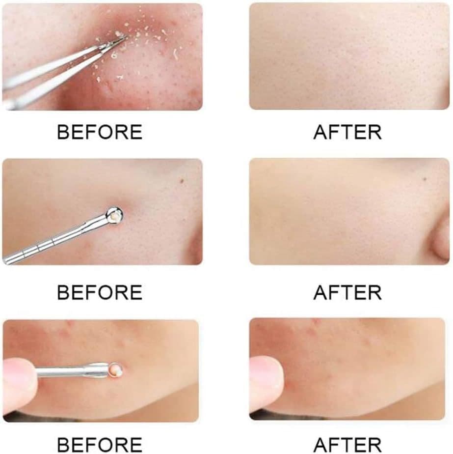 KAV Comedone Extractor Kit 5-Piece Blackhead Remover Tool Set with Storage Case image 5