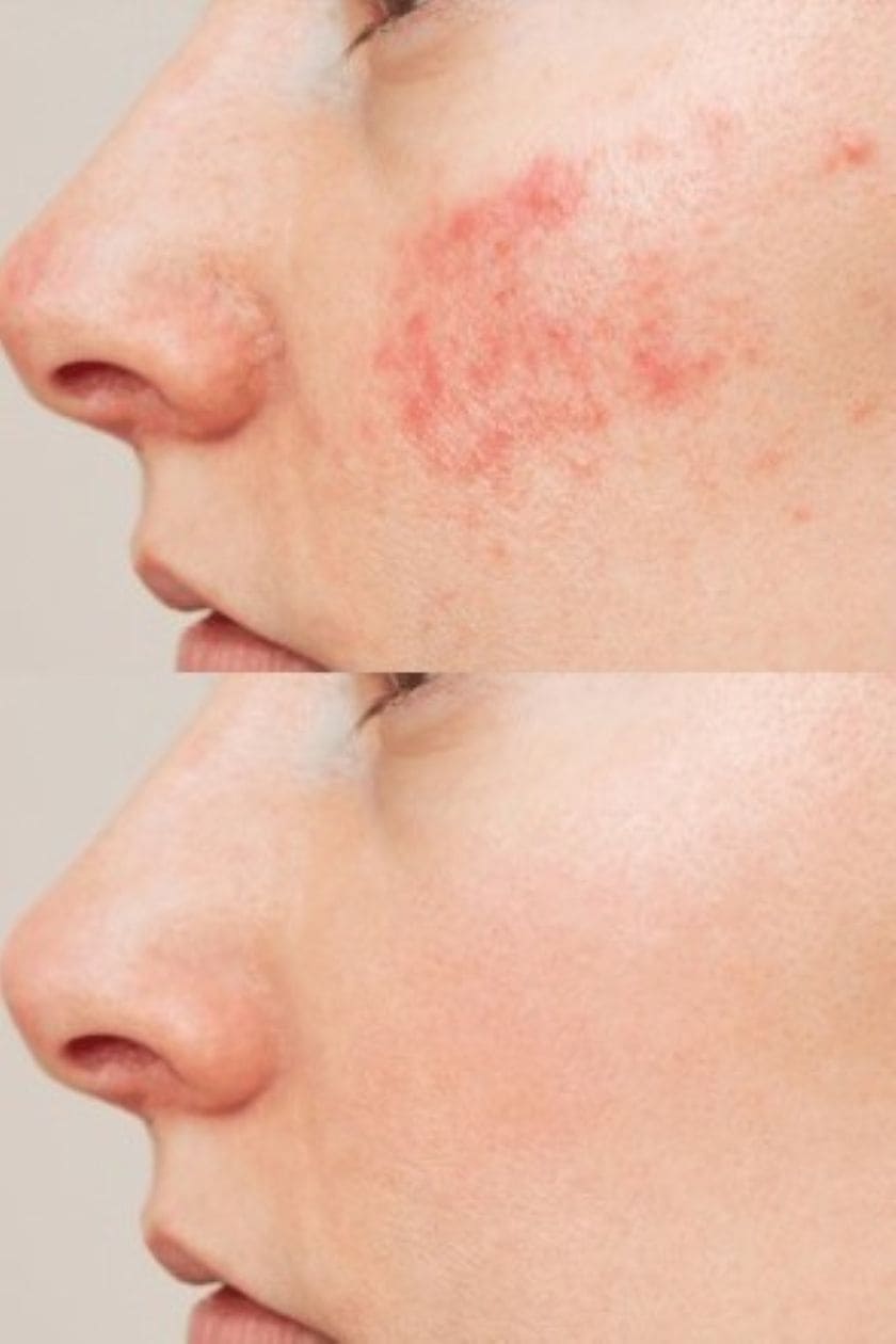 StarGate ClearSkin Glow II LED Mask Reduce Wrinkles & Boost Anti-Ageing Glow image 2