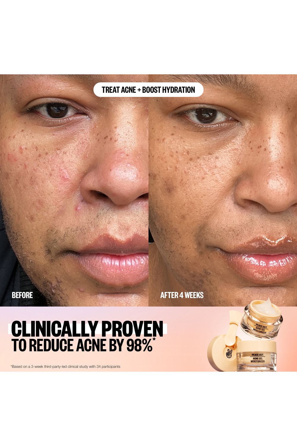 Peace Out Acne Moisturiser with 2% Salicylic Acid 50ml Multi image 5